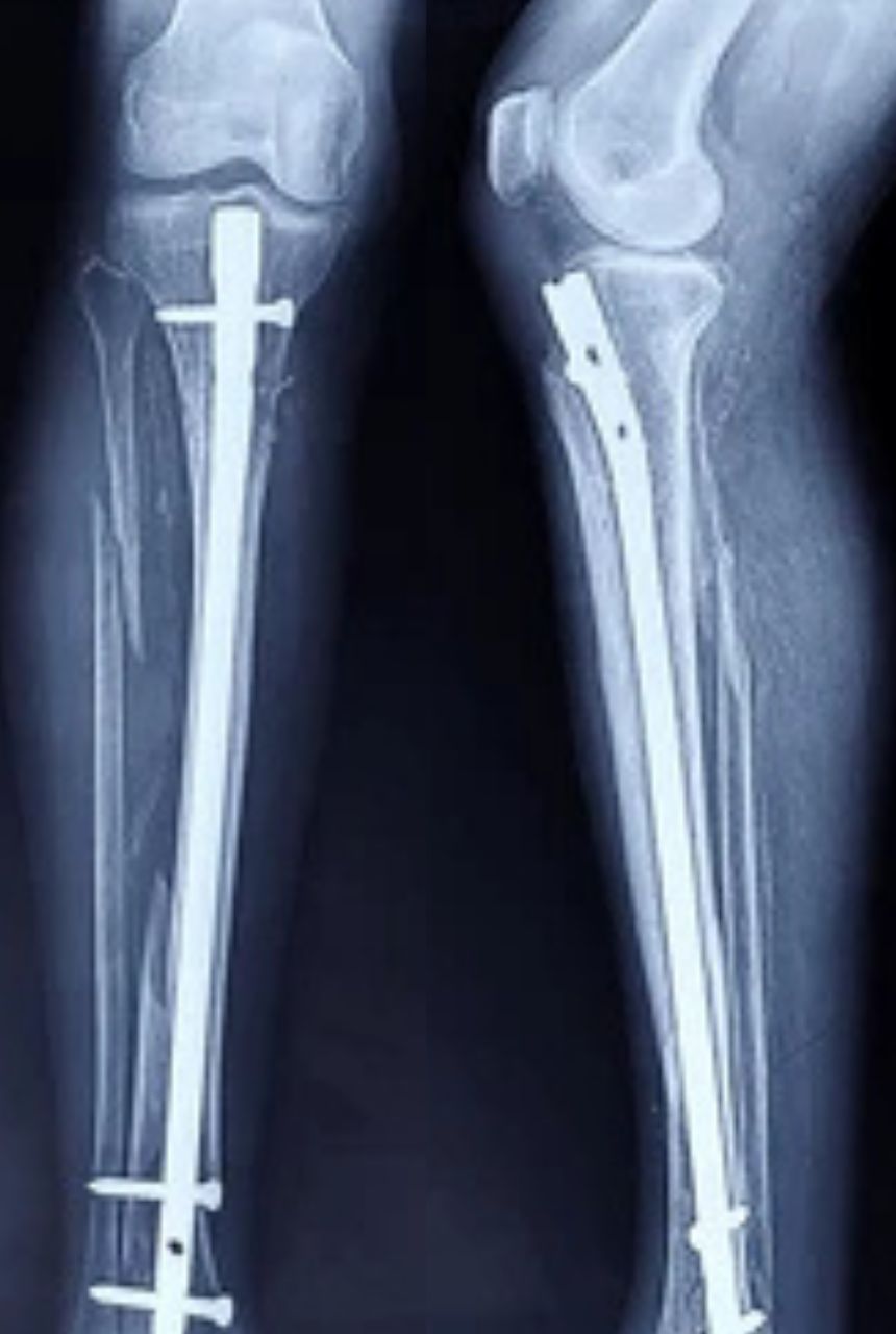 intramedullary nail