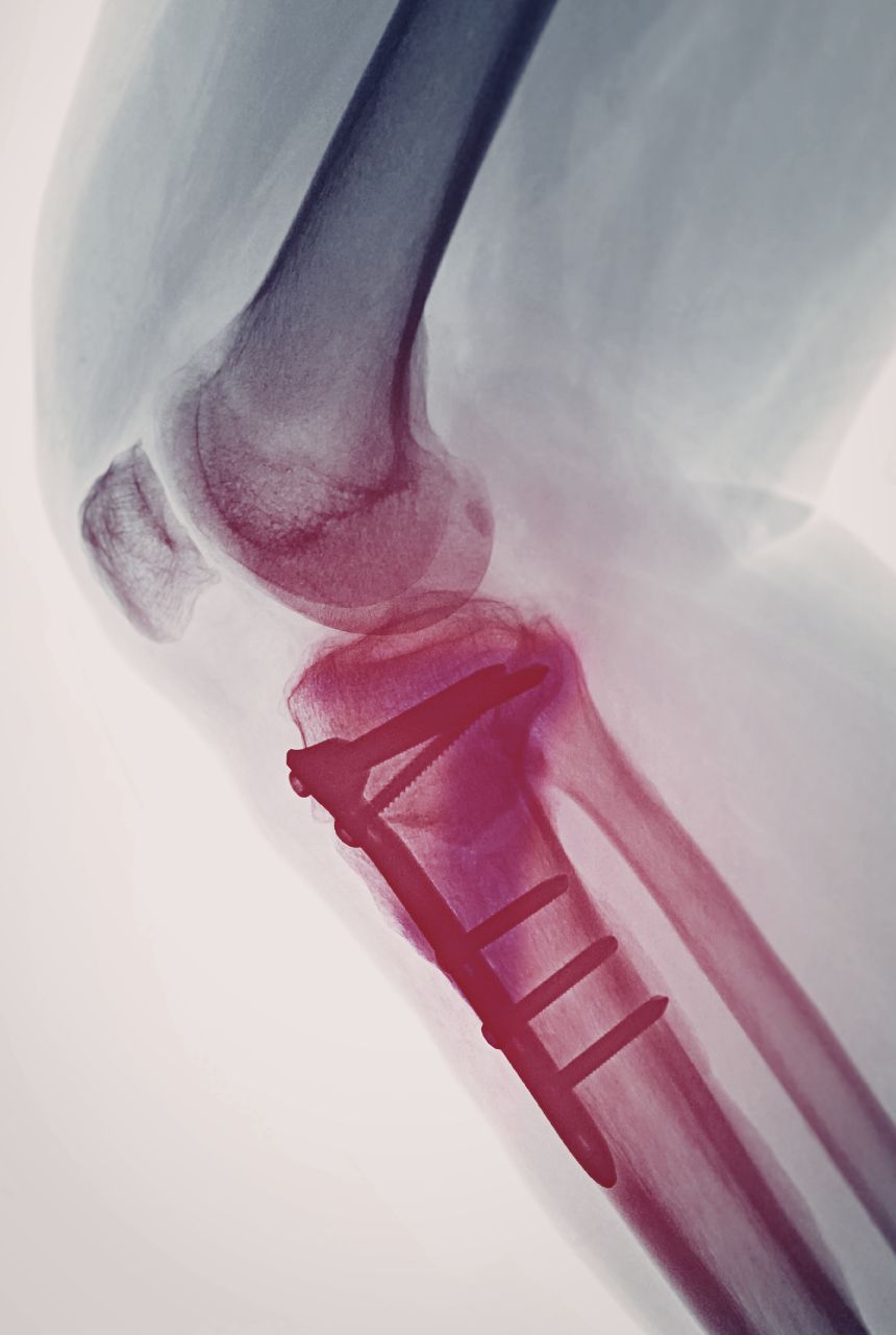 trauma plates